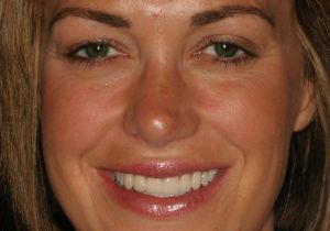 Trial-Smile-4.jpg